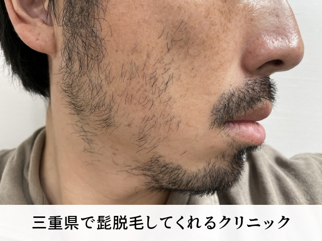 三重県で髭脱毛してくれるクリニック